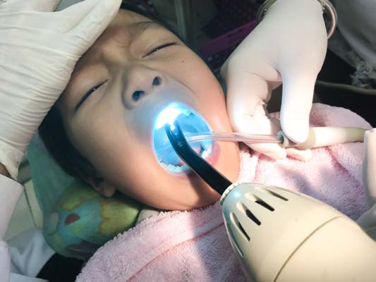 What Are The Benefits Of Dental Sealants For Kids?